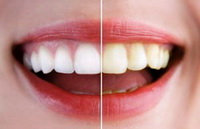Профилактика потемнения зубов